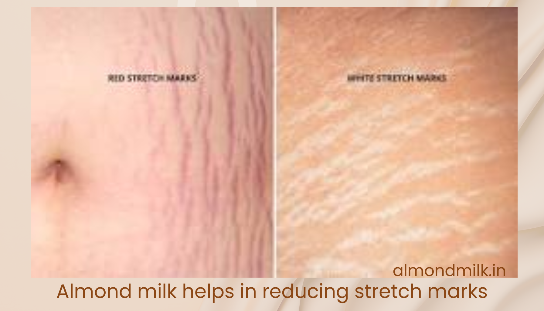 Almond Oil Helps Reduce Stretch Marks
